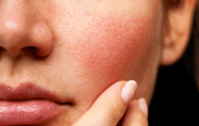 15 Rekomendasi Skincare untuk Kulit Sensitif Agar Tetap Bersih dan&nbsp;Terawat